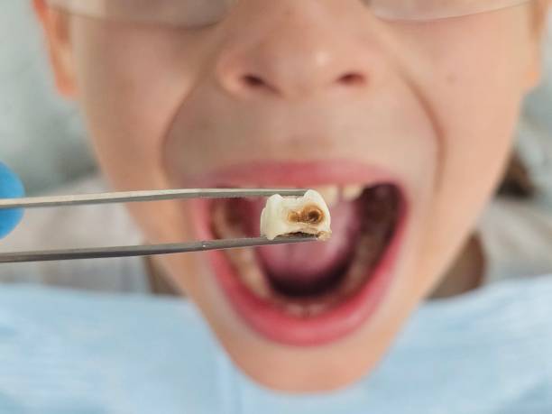 Best Emergency Wisdom Tooth Extraction in Eastland, TX
